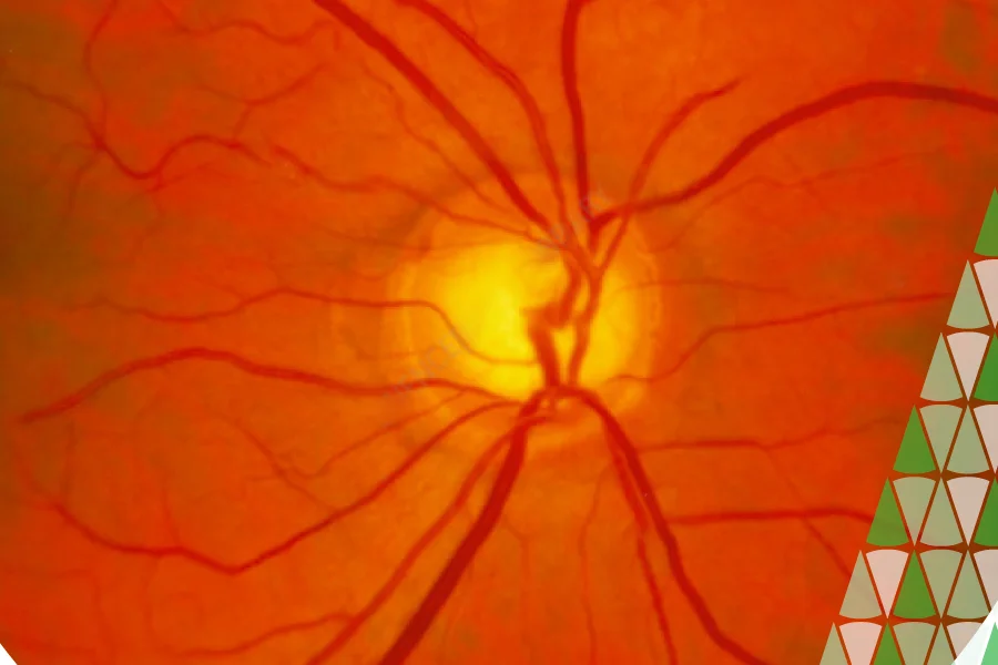 glaucoma